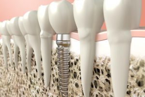 Same-Day Dental Implants Service