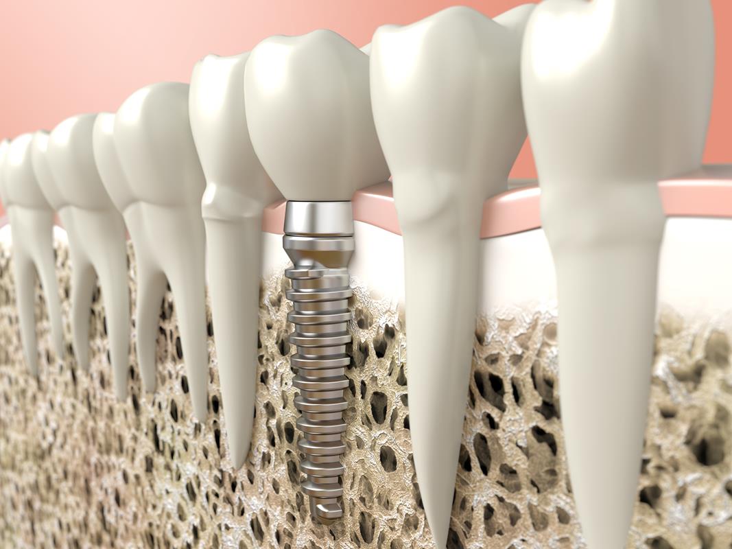 Affordable Dental Implants Walnut Creek CA