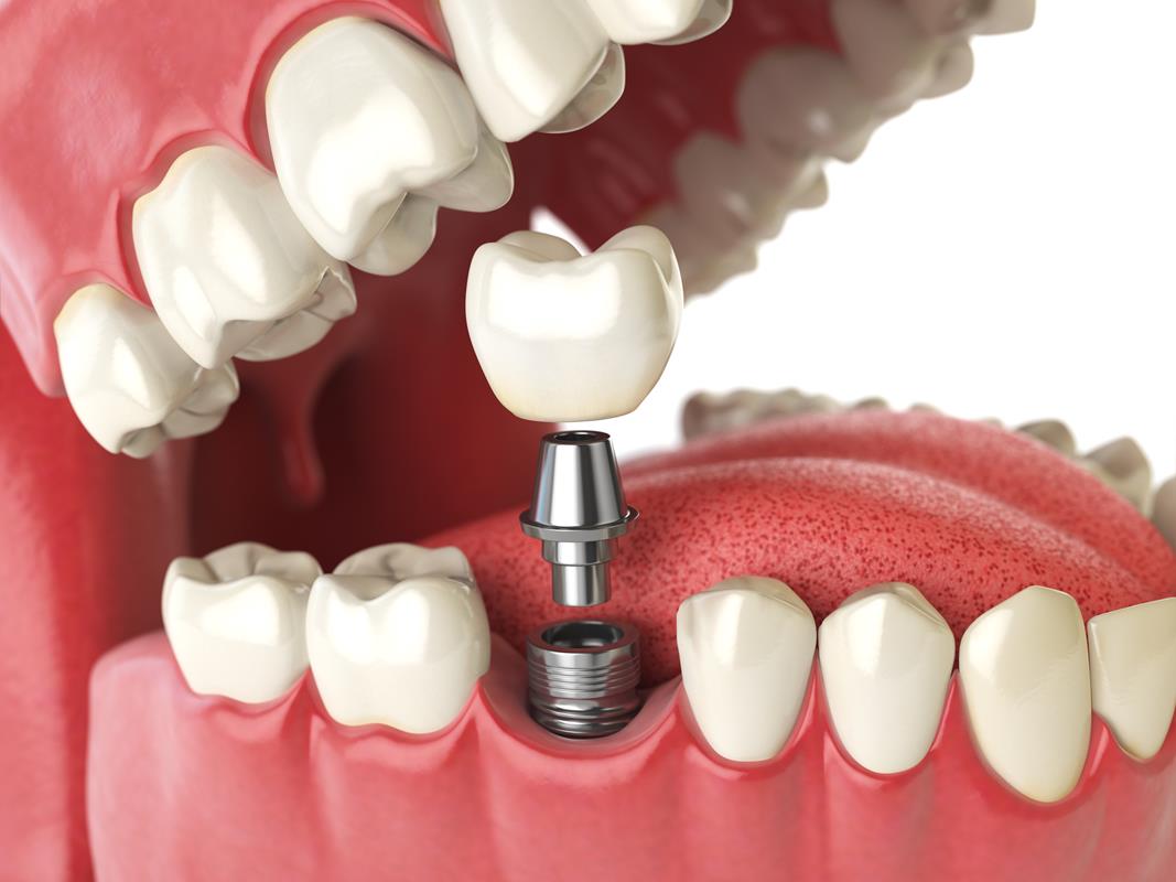 Dental Implants Expert Walnut Creek CA