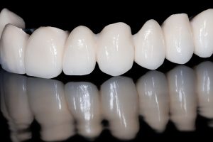 Composite Veneers Implant