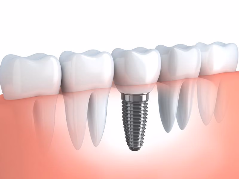 Dental Implant Expert