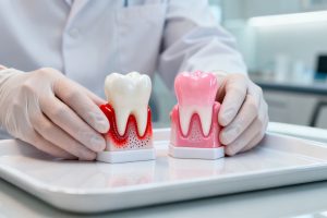 Root Canal Treatment