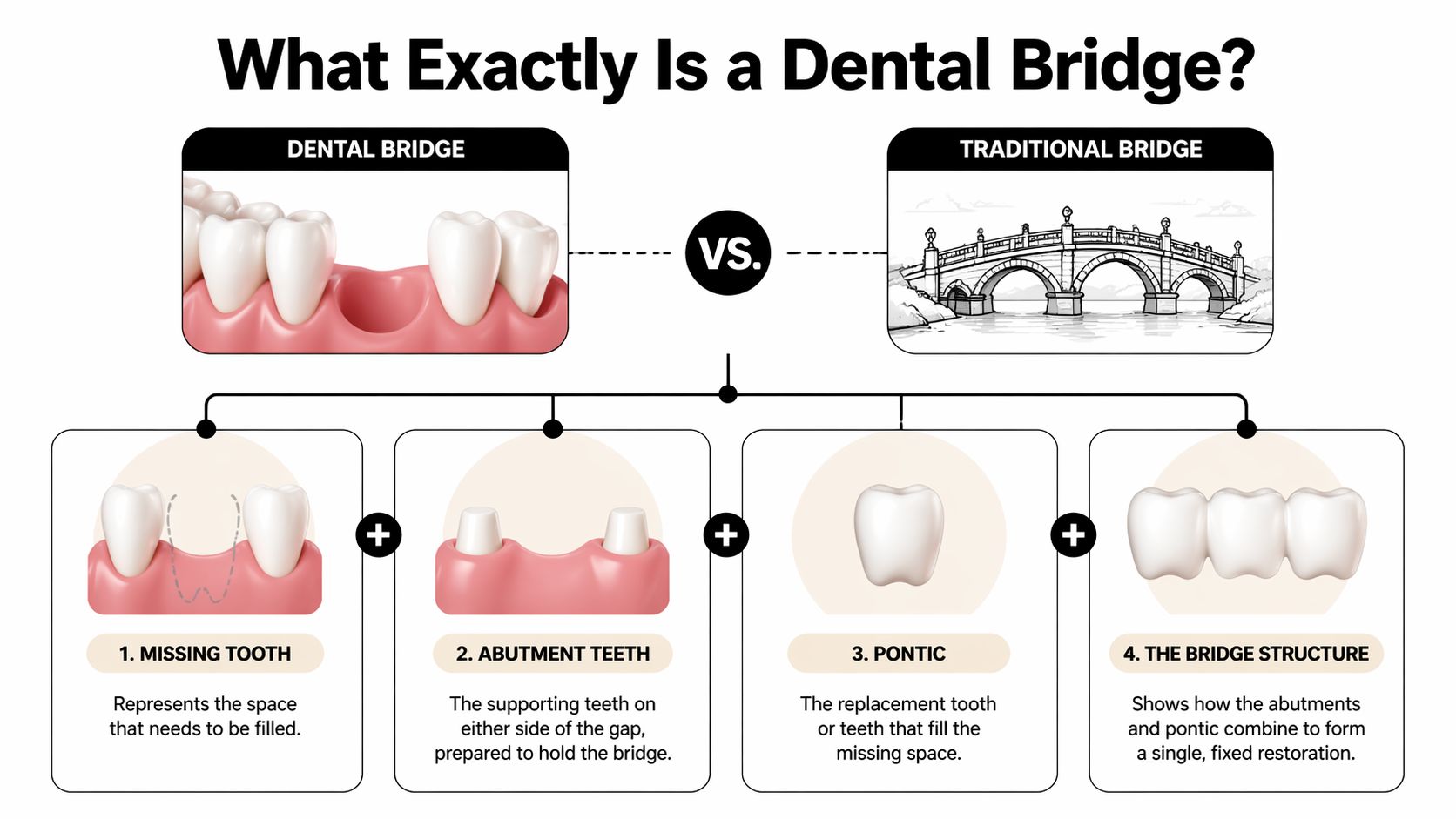 A dental infographic illustrating the components of a dental bridge including abutment teeth and the pontic.