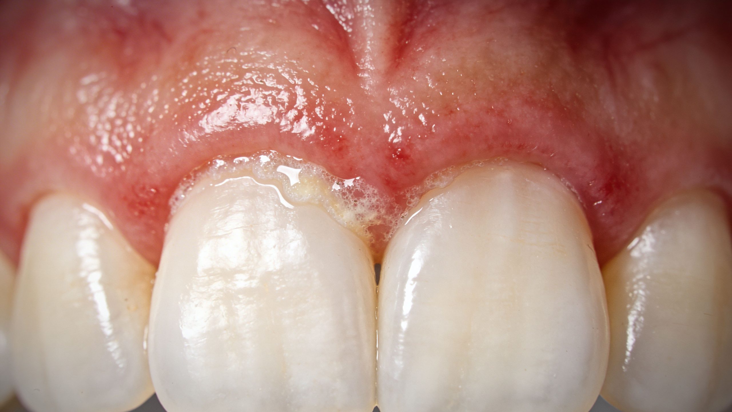 Close-up of human upper front teeth showing inflamed, red gums with plaque accumulation and oral debris.