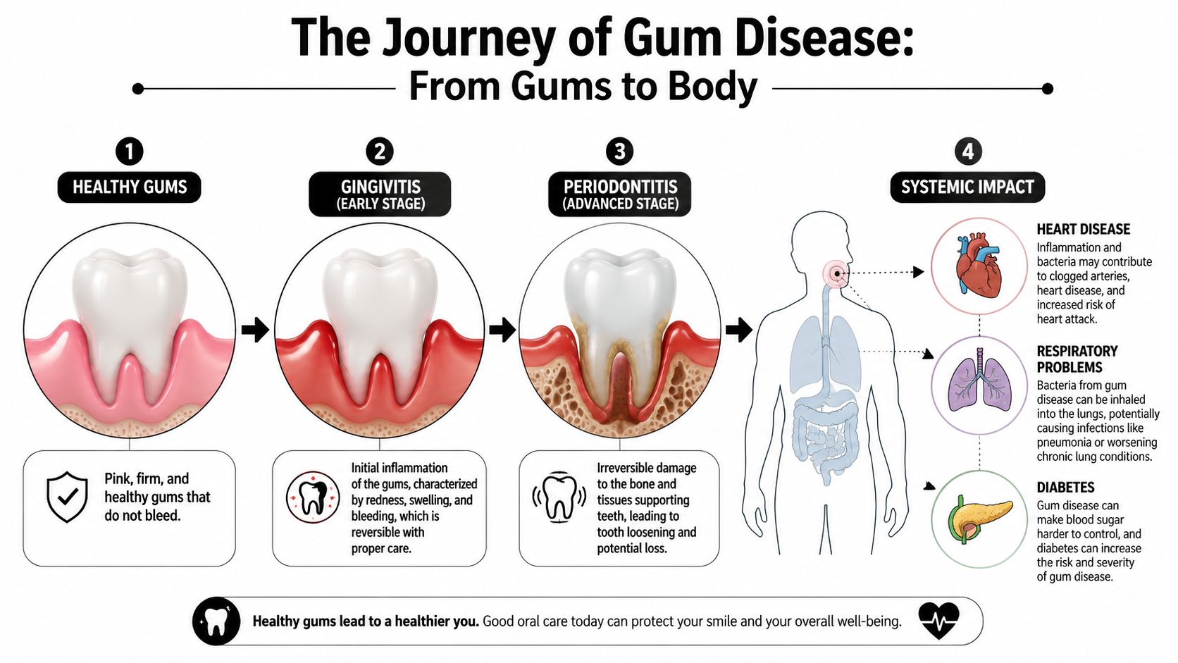 A diagram illustrating the progression of gum disease from gingivitis to periodontitis and its systemic health risks.