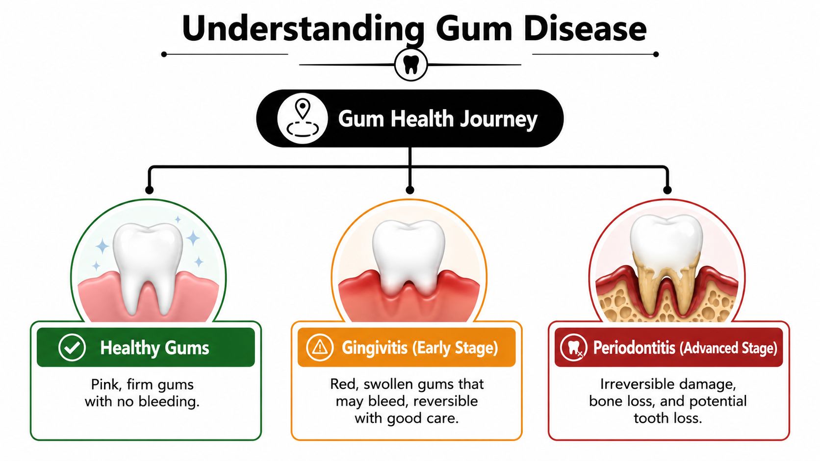 A diagram illustrating the three stages of gum health: healthy gums, gingivitis, and advanced periodontitis.
