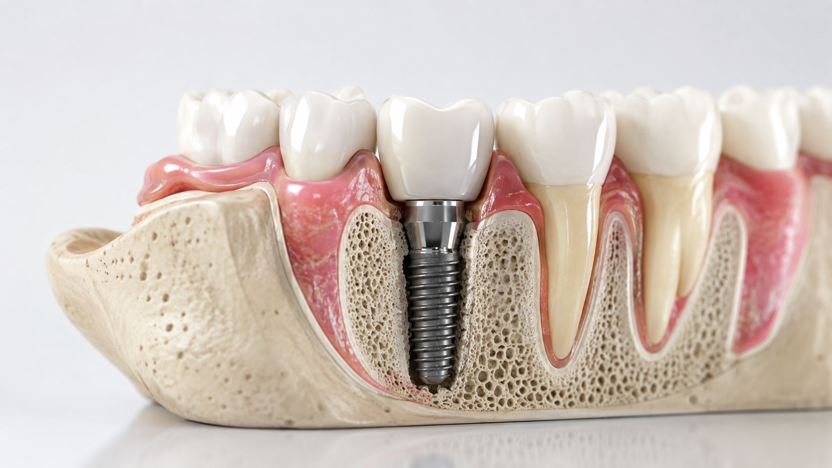 A 3D model showing a dental implant procedure integrated into the jawbone and gum tissue.