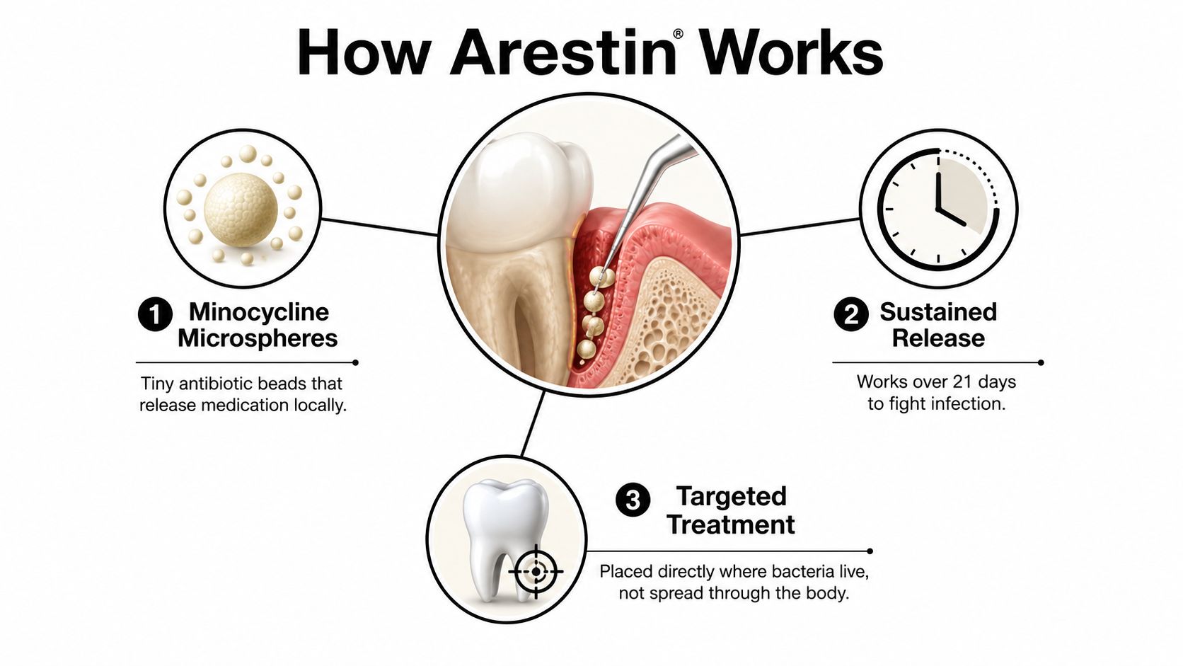 An infographic showing how Arestin works with microspheres, sustained release, and targeted dental treatment.