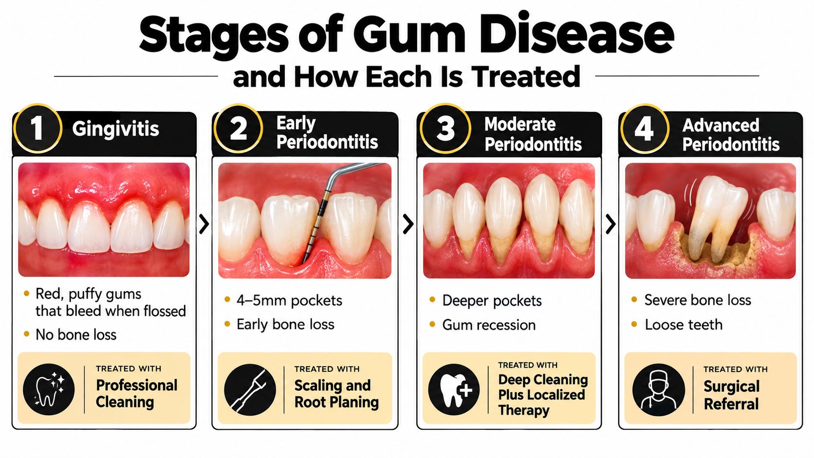 An infographic detailing the four stages of gum disease, from gingivitis to advanced periodontitis, and their respective treatments.