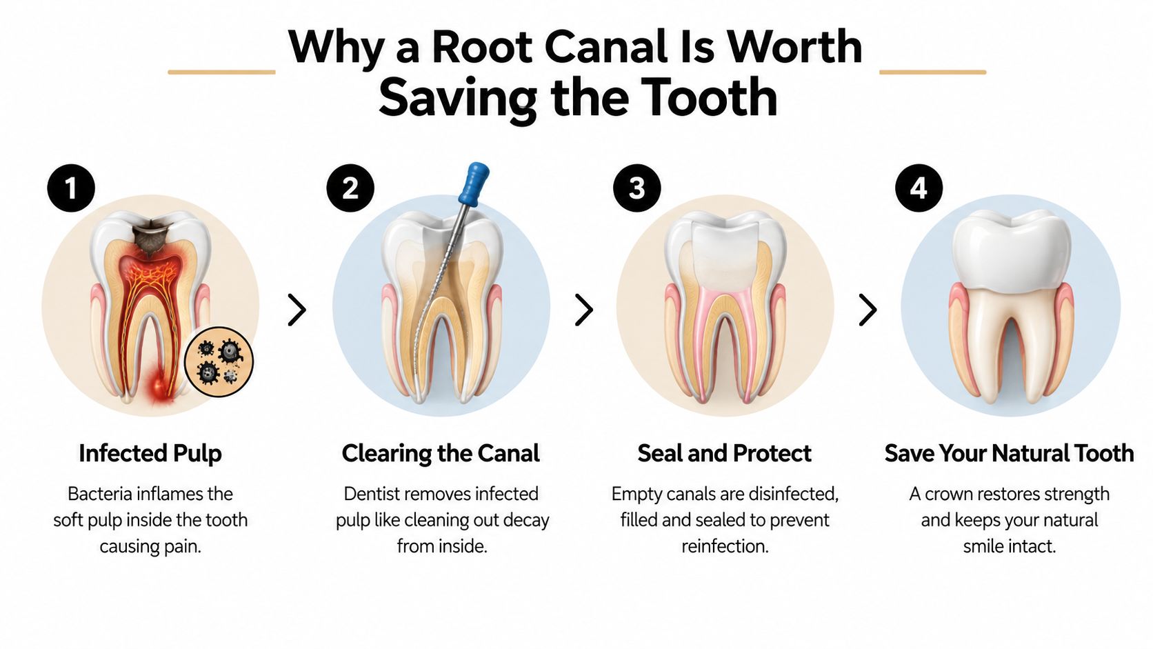 A four-step infographic illustrating the root canal procedure to save an infected natural tooth with a crown.